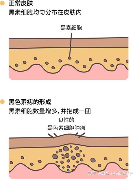 痣 凸起|痣也可能会癌变！长在 3 个地方要注意